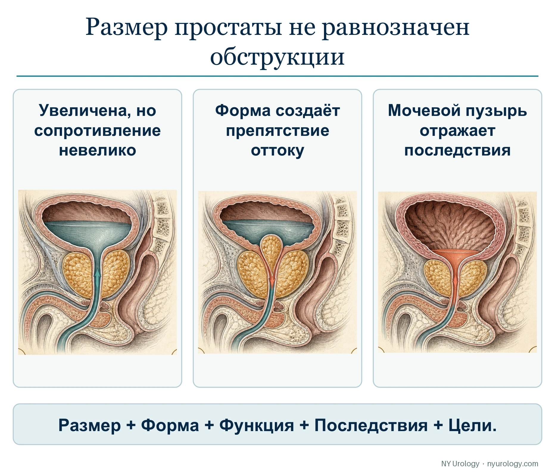 Размер простаты не равнозначен обструкции
